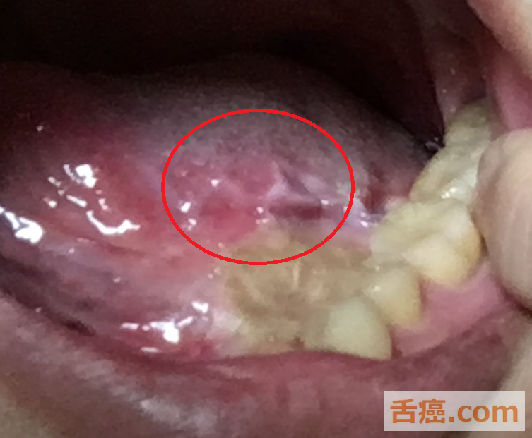 舌癌の手術跡の画像