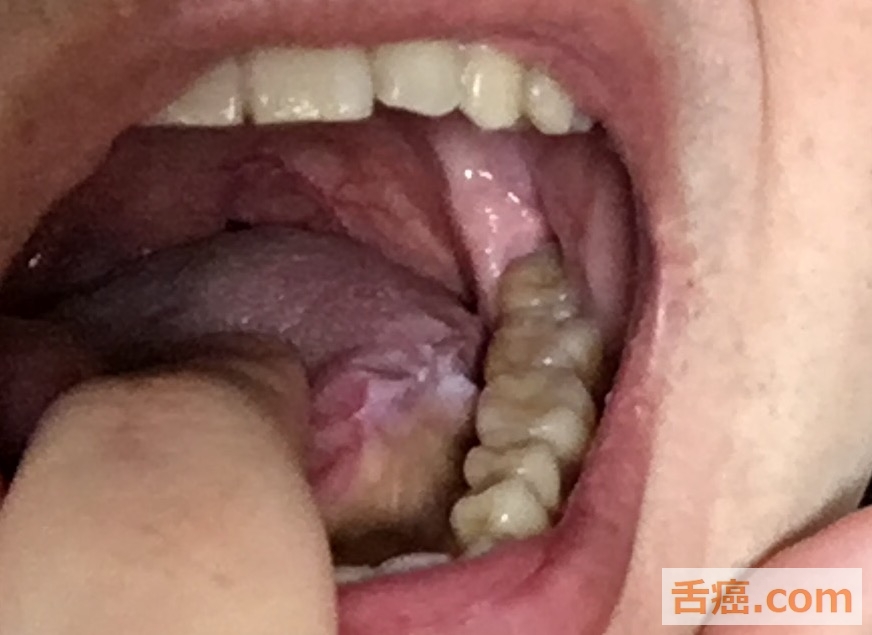 舌癌の手術跡は舌がガタガタ