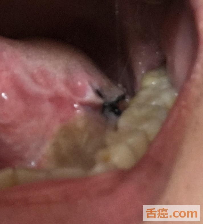 舌癌の予防手術跡