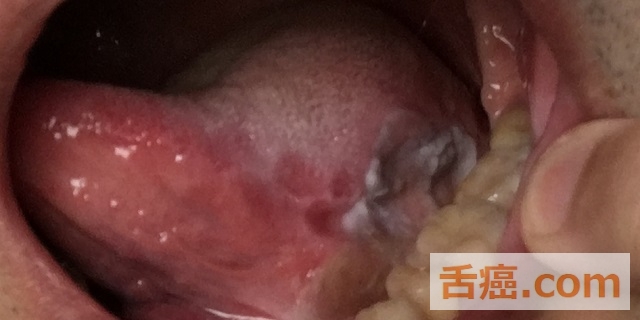 手術後37日目の舌の様子